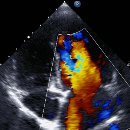 Echocardiography